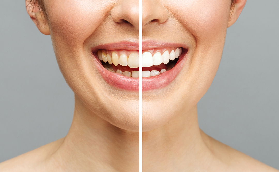 face of a woman separated by white line to show outcome of dental cosmetic procedure