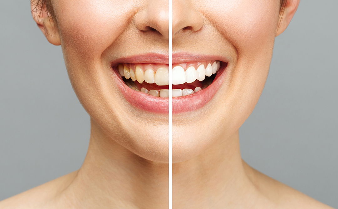 face of a woman separated by white line to show outcome of dental cosmetic procedure